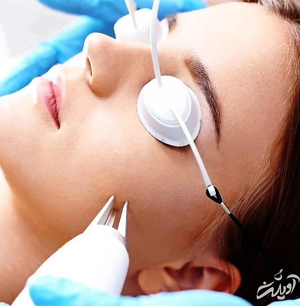 اربیوم لیزر